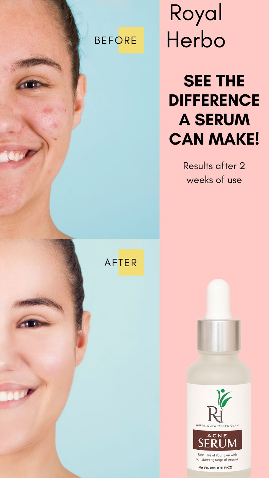 Acne Serum