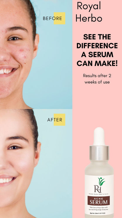 Acne Serum